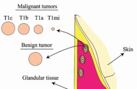 Professor e aluno da UEMA publicam artigo sobre o câncer de mama em revista internacional Qualis A1